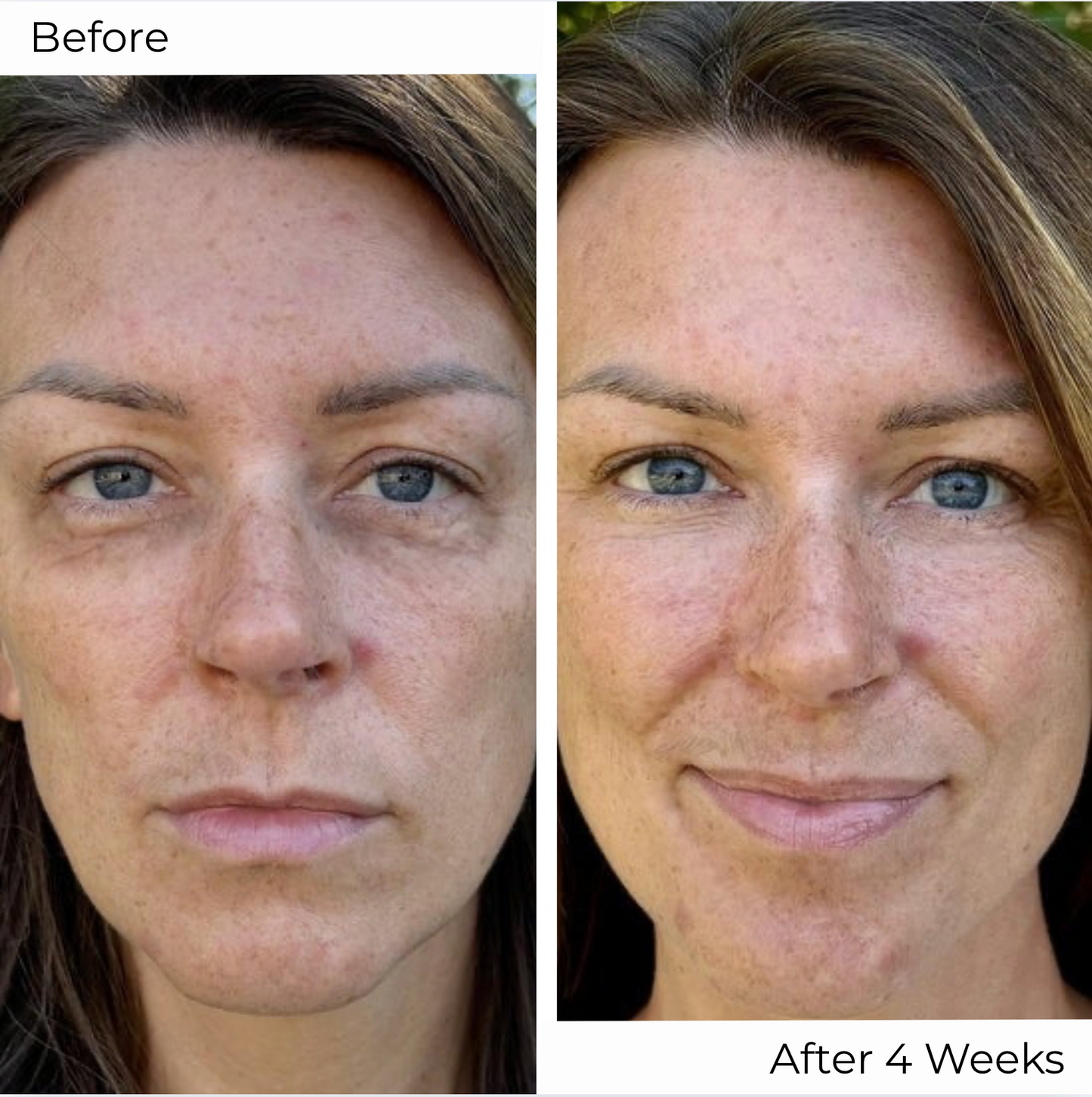 VoluCell™ - Micro-needle Patches